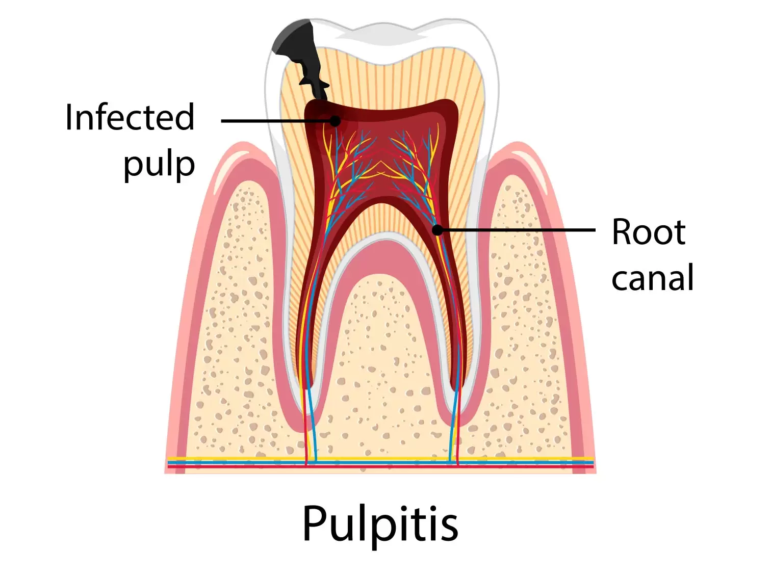 Схематичне зображення структури зуба хворого на пульпіт